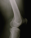 bone-health